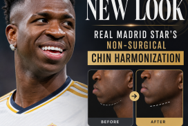 Vinícius Júnior smiling, highlighting his natural-looking chin after non-surgical harmonization treatment.